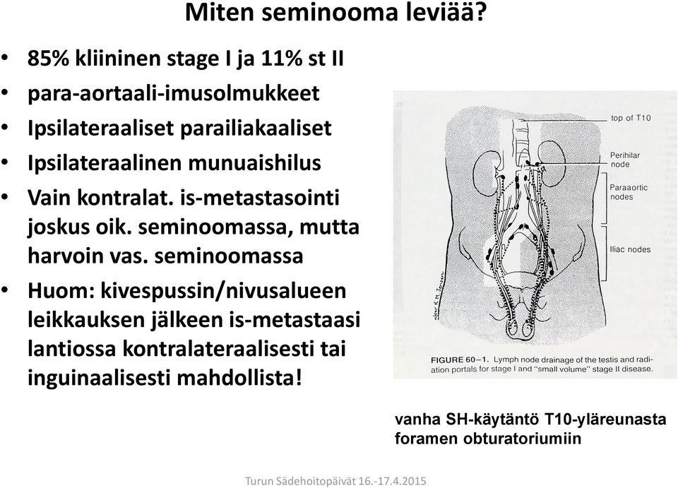 Ipsilateraalinen munuaishilus Vain kontralat. is-metastasointi joskus oik. seminoomassa, mutta harvoin vas.