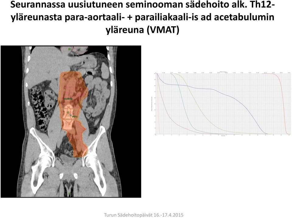 Th12- yläreunasta para-aortaali-