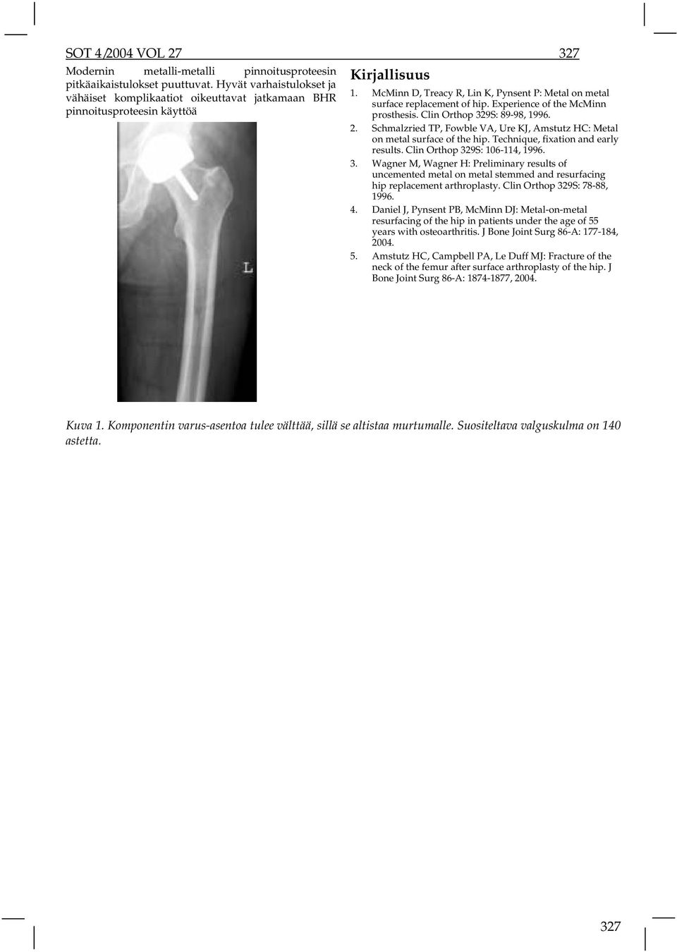 Clin Orthop 329S: 89-98, 1996. 2. Schmalzried TP, Fowble VA, Ure KJ, Amstutz HC: Metal on metal surface of the hip. Technique, fixation and early results. Clin Orthop 329S: 106-114, 1996. 3. Wagner M, Wagner H: Preliminary results of uncemented metal on metal stemmed and resurfacing hip replacement arthroplasty.