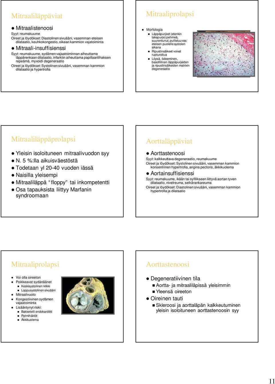 dilataatio ja hypertrofia Mitraaliprolapsi Morfologia Läppäpurjeet (etenkin takapurje) pehmeä, suurentunut, pullistuu vas eteisen puolelle systolen aikana Ripustinsäikeet voivat rupturoitua Löysä,