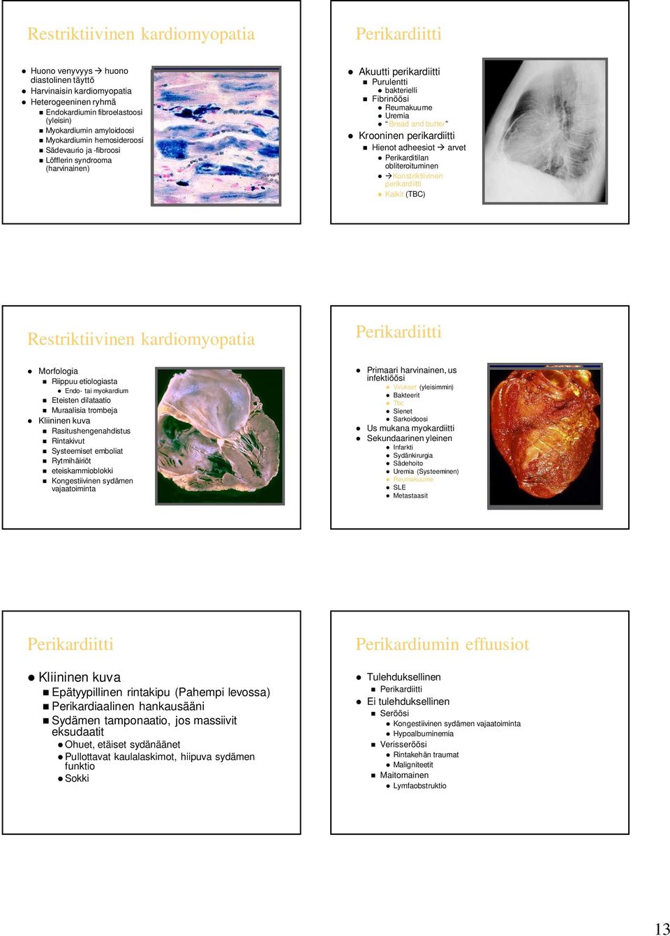 Hienot adheesiot arvet Perikarditilan obliteroituminen Konstriktiivinen perikardiitti Kalkit (TBC) Restriktiivinen kardiomyopatia Perikardiitti Morfologia Riippuu etiologiasta Endo- tai myokardium