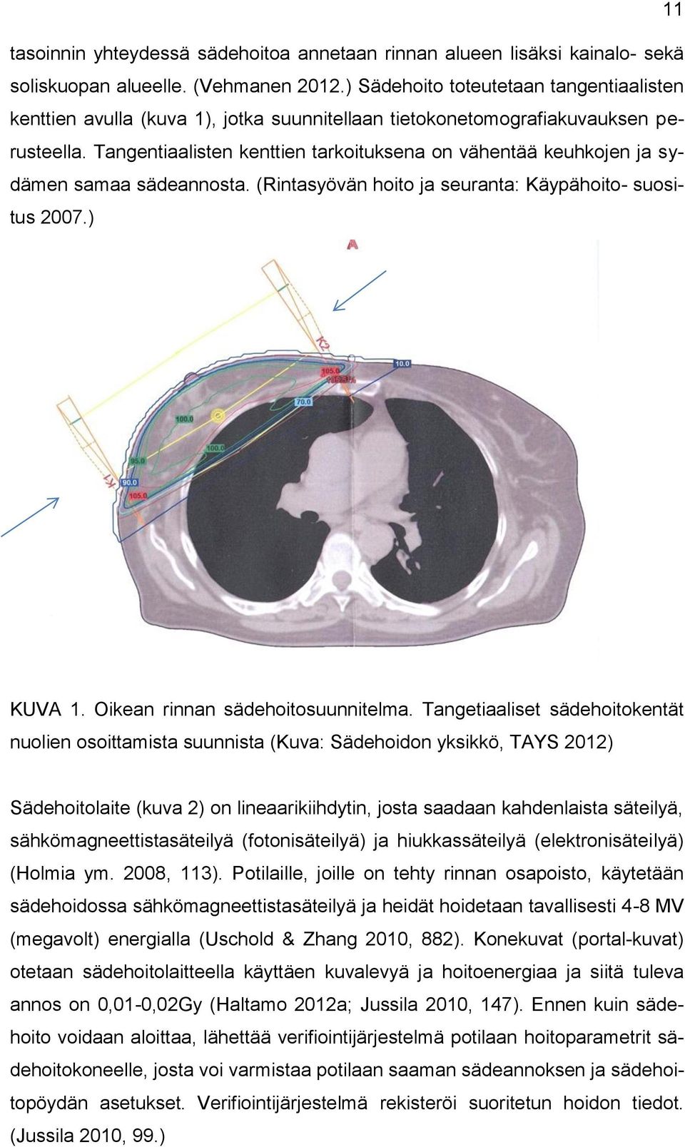Tangentiaalisten kenttien tarkoituksena on vähentää keuhkojen ja sydämen samaa sädeannosta. (Rintasyövän hoito ja seuranta: Käypähoito- suositus 2007.) KUVA 1. Oikean rinnan sädehoitosuunnitelma.