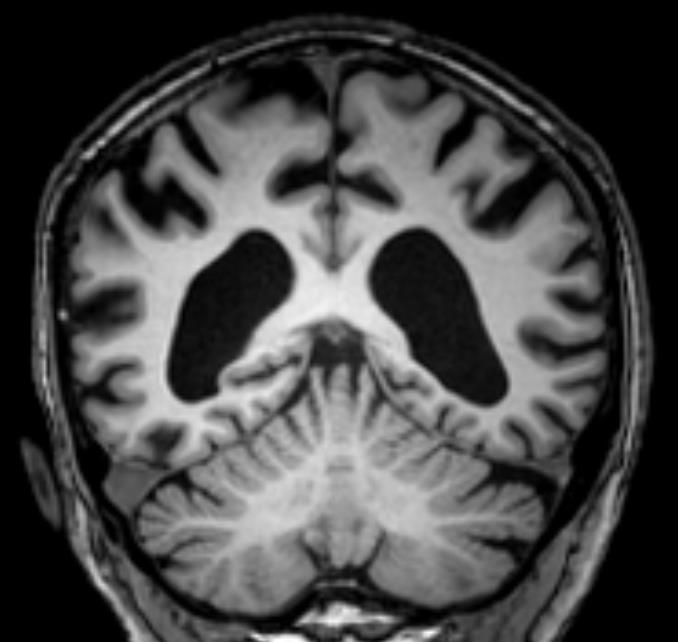 Posteriorinen atrofia * =Precuneus Posteriorinen sulcus cinguli * Fissura parieto-occipitalis Parietaalilohkot Posteriorisessa kortikaalisessa atrofiassa voidaan atrofian arvioimisessa hyödyntää