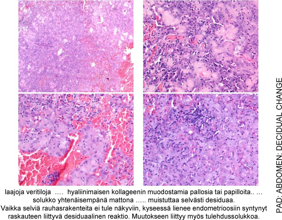 Vaikka selviä rauhasrakenteita ei tule näkyviin, kyseessä lienee endometrioosiin