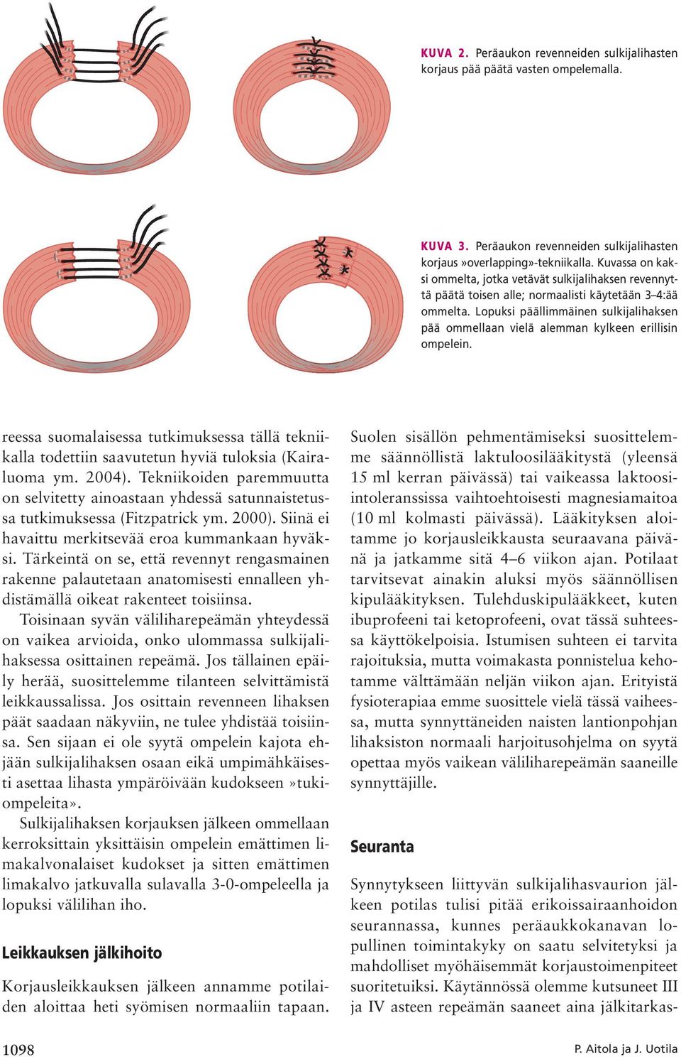 Lopuksi päällimmäinen sulkijalihaksen pää ommellaan vielä alemman kylkeen erillisin ompelein. reessa suomalaisessa tutkimuksessa tällä tekniikalla todettiin saavutetun hyviä tuloksia (Kairaluoma ym.
