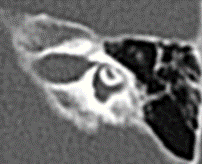 21 Kuva 13. Potilaan 4 oikea simpukka, normaali basaalikierre, keskikierre ja apikaalinen osa (valkoinen nuoli). Kuva 14.
