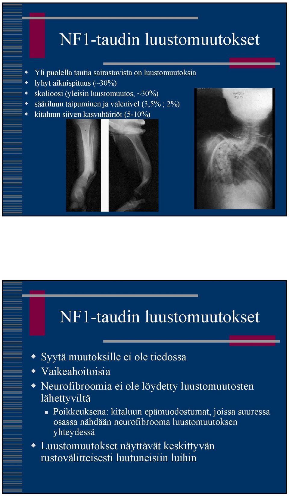 muutoksille ei ole tiedossa Vaikeahoitoisia Neurofibroomia ei ole löydetty luustomuutosten lähettyviltä Poikkeuksena: kitaluun