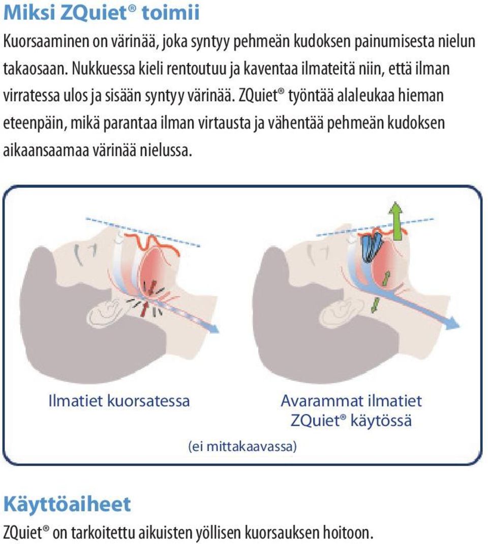 ZQuiet työntää alaleukaa hieman eteenpäin, mikä parantaa ilman virtausta ja vähentää pehmeän kudoksen aikaansaamaa värinää