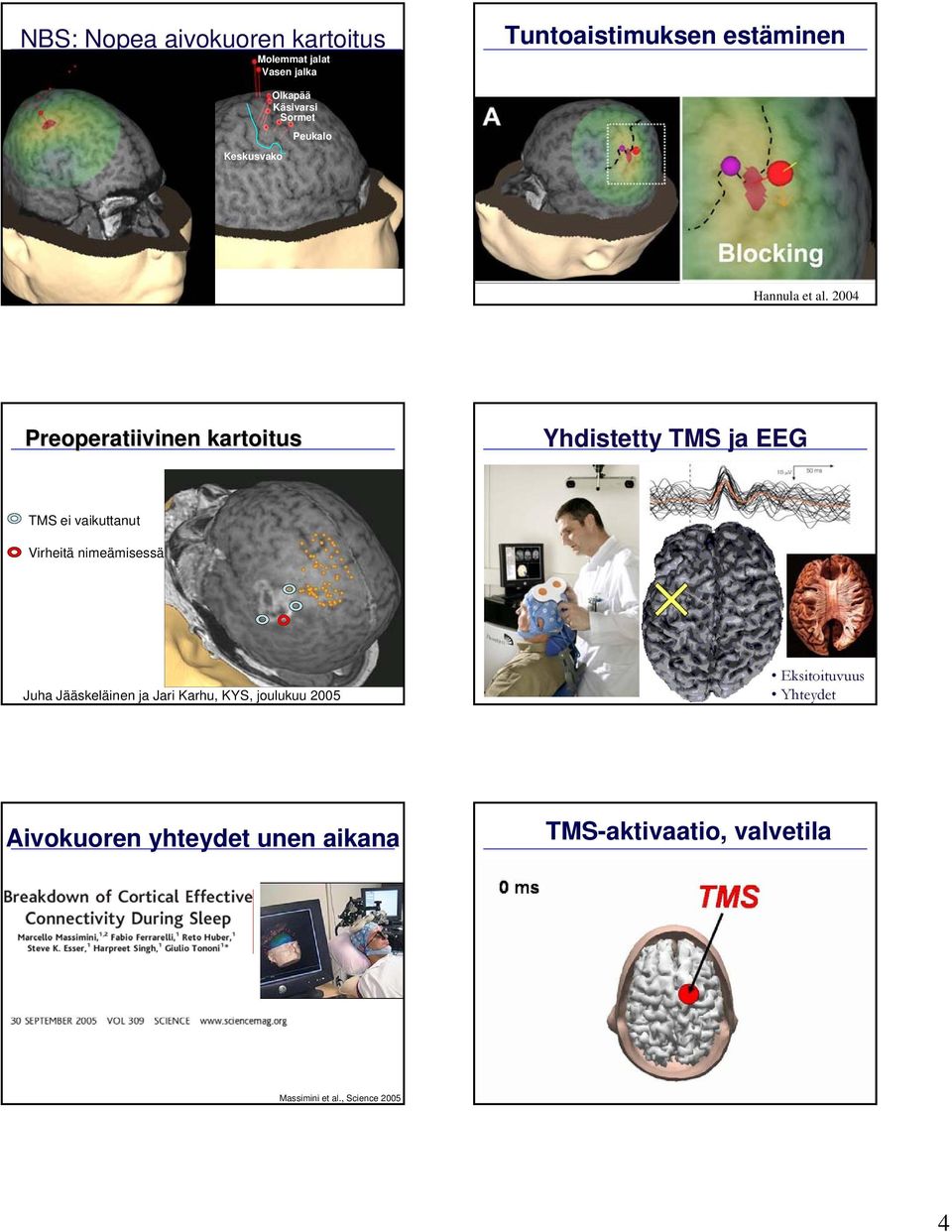 2004 Preoperatiivinen kartoitus Yhdistetty TMS ja EEG TMS ei vaikuttanut Virheitä nimeämisessä Juha