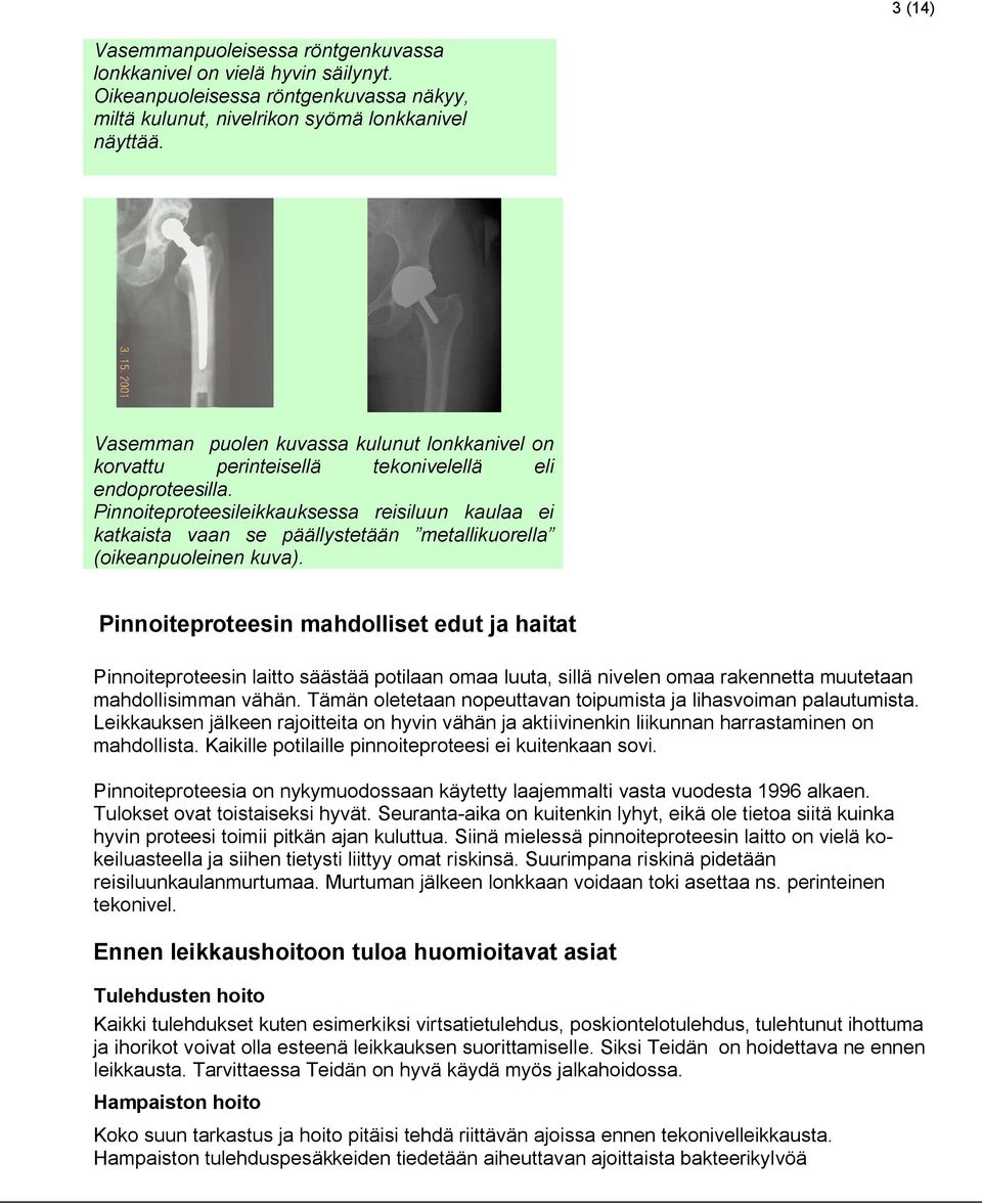 Pinnoiteproteesileikkauksessa reisiluun kaulaa ei katkaista vaan se päällystetään metallikuorella (oikeanpuoleinen kuva).