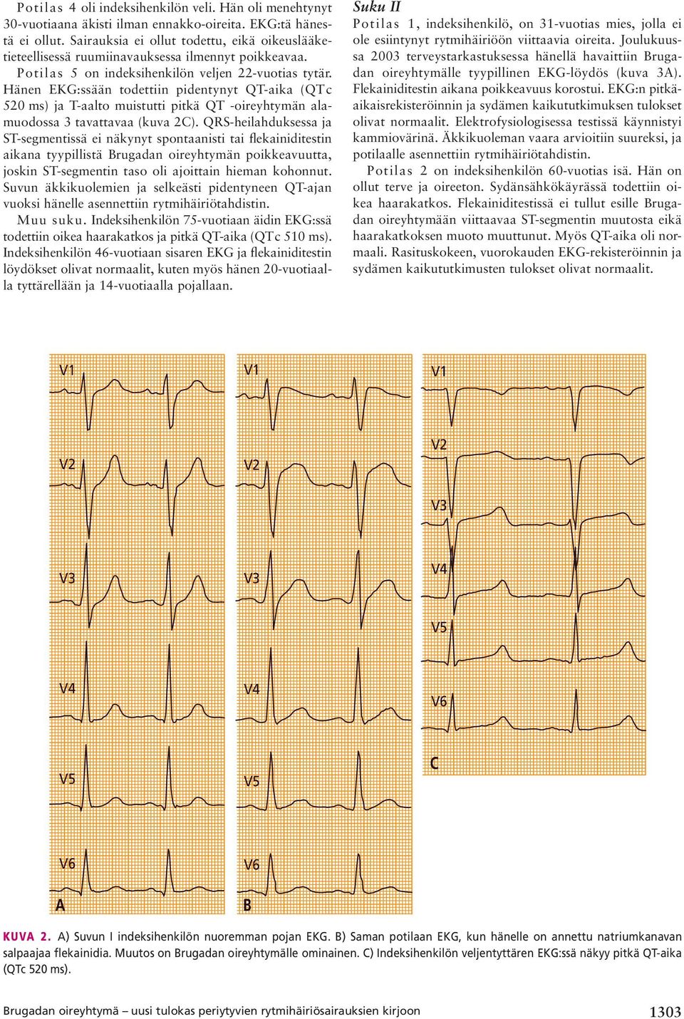 Hänen EKG:ssään todettiin pidentynyt QT-aika (QTc 520 ms) ja T-aalto muistutti pitkä QT -oireyhtymän alamuodossa 3 tavattavaa (kuva 2C).