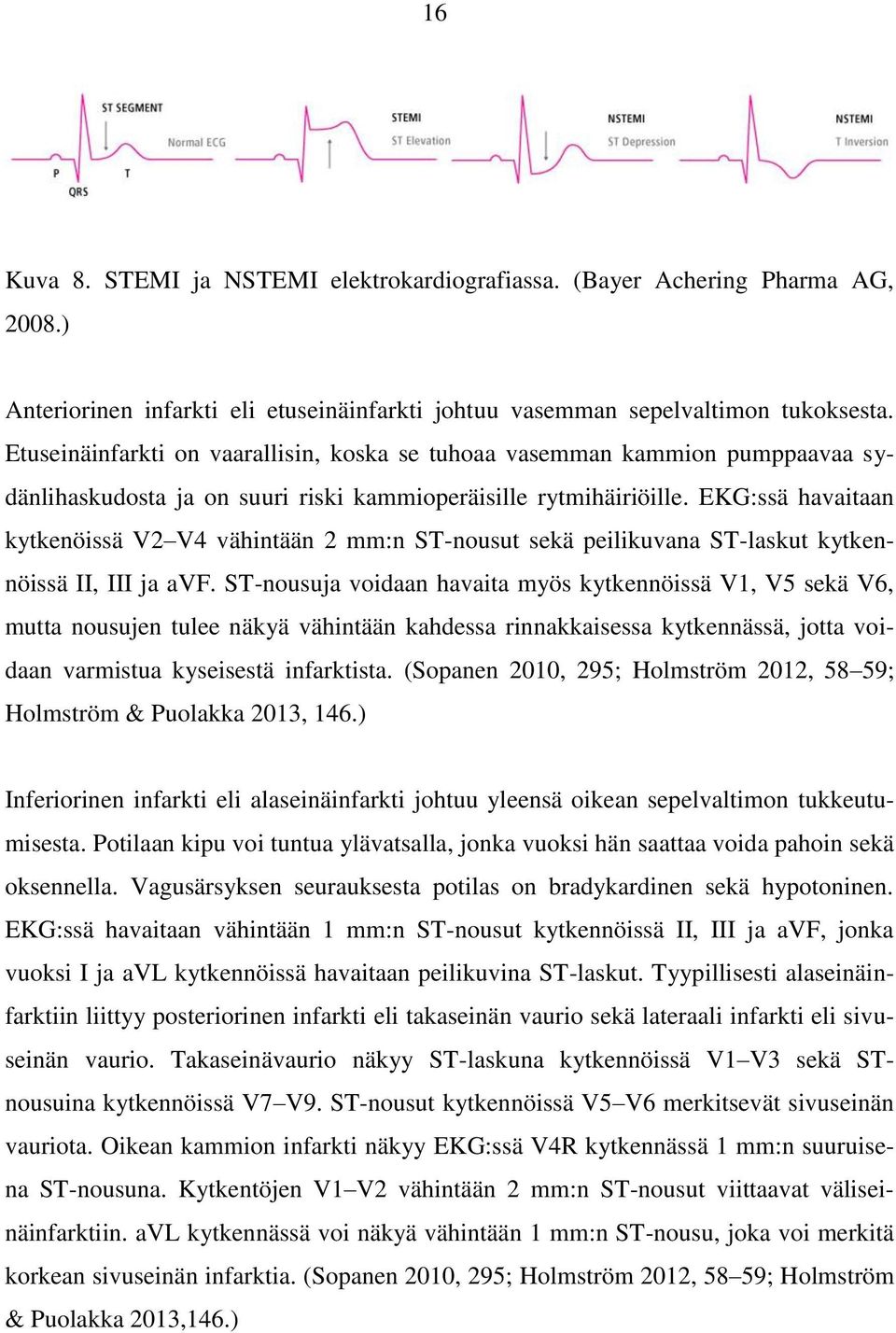 EKG:ssä havaitaan kytkenöissä V2 V4 vähintään 2 mm:n ST-nousut sekä peilikuvana ST-laskut kytkennöissä II, III ja avf.