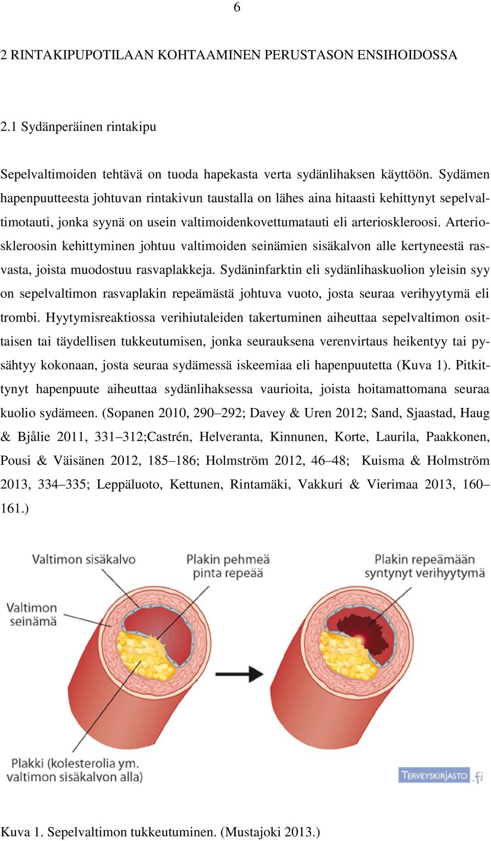 Arterioskleroosin kehittyminen johtuu valtimoiden seinämien sisäkalvon alle kertyneestä rasvasta, joista muodostuu rasvaplakkeja.