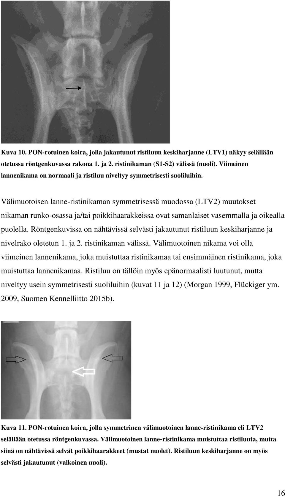 Välimuotoisen lanne-ristinikaman symmetrisessä muodossa (LTV2) muutokset nikaman runko-osassa ja/tai poikkihaarakkeissa ovat samanlaiset vasemmalla ja oikealla puolella.