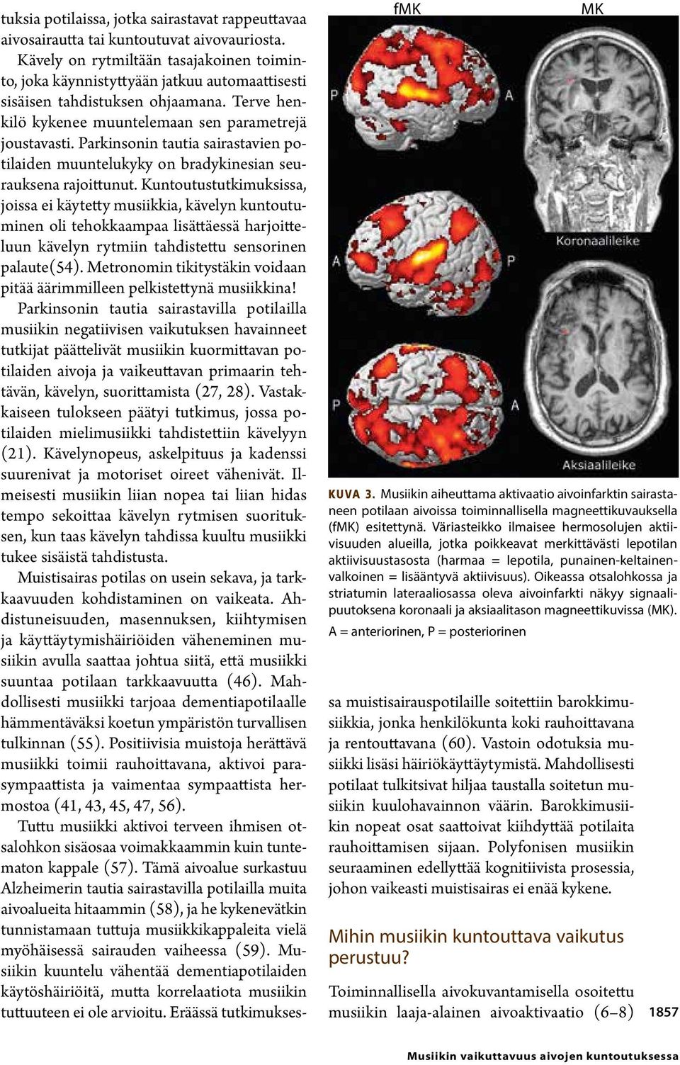 Oikeassa otsalohkossa ja striatumin lateraaliosassa oleva aivoinfarkti näkyy signaalipuutoksena koronaali ja aksiaalitason magneettikuvissa (MK).