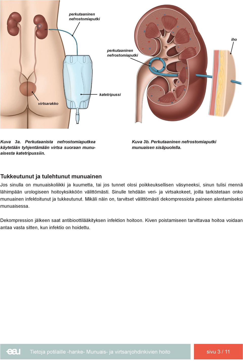 Tukkeutunut ja tulehtunut munuainen Jos sinulla on munuaiskoliikki ja kuumetta, tai jos tunnet olosi poikkeuksellisen väsyneeksi, sinun tulisi mennä lähimpään urologiseen hoitoyksikköön välittömästi.
