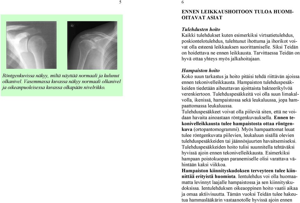 Röntgenkuvissa näkyy, miltä näyttää normaali ja kulunut olkanivel. Vasemmassa kuvassa näkyy normaali olkanivel ja oikeanpuoleisessa kuvassa olkapään nivelrikko.