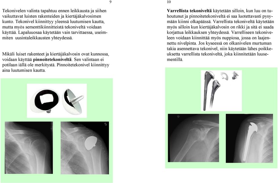 Mikäli luiset rakenteet ja kiertäjäkalvosin ovat kunnossa, voidaan käyttää pinnoitetekoniveltä. Sen valintaan ei potilaan iällä ole merkitystä. Pinnoitetekonivel kiinnittyy aina luutumisen kautta.