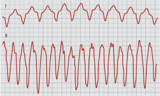 11 Kammiotakykardian (ventricular tachycardia) taustalla on yleensä vaikea sydänlihasvaurio, myrkytys, elektrolyyttihäiriö, pitkä QT-aika tai myös periytyvä taipumus.