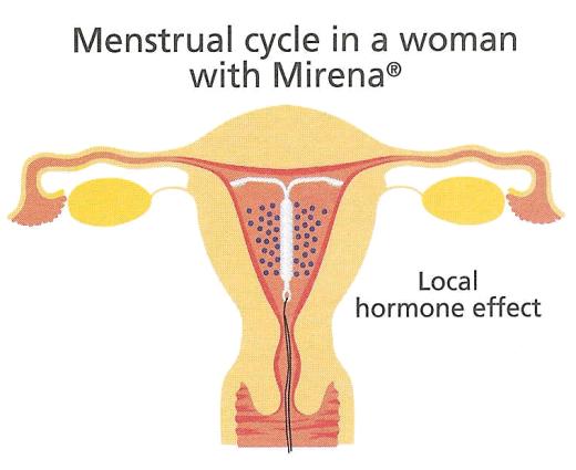 MIRENA -vaikutus endometriumiin Normaali kuukautiskierto Kuukautiskierto MIRENA -käyttäjällä