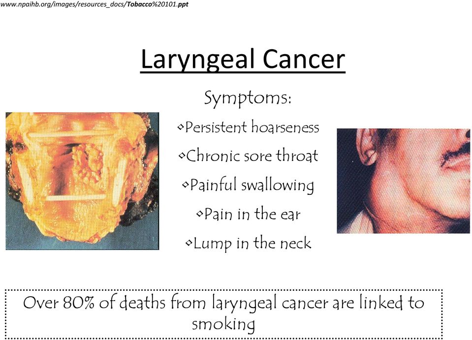 Chronic sore throat Painful swallowing Pain in the ear Lump