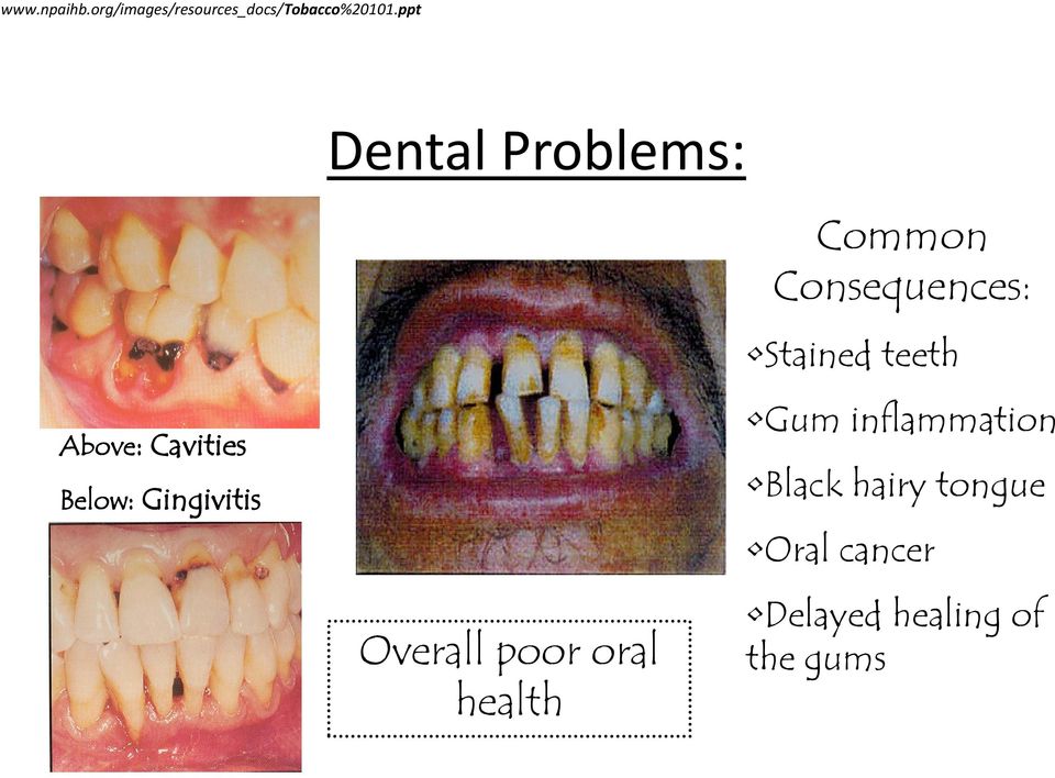Overall poor oral health Common Consequences: Stained teeth