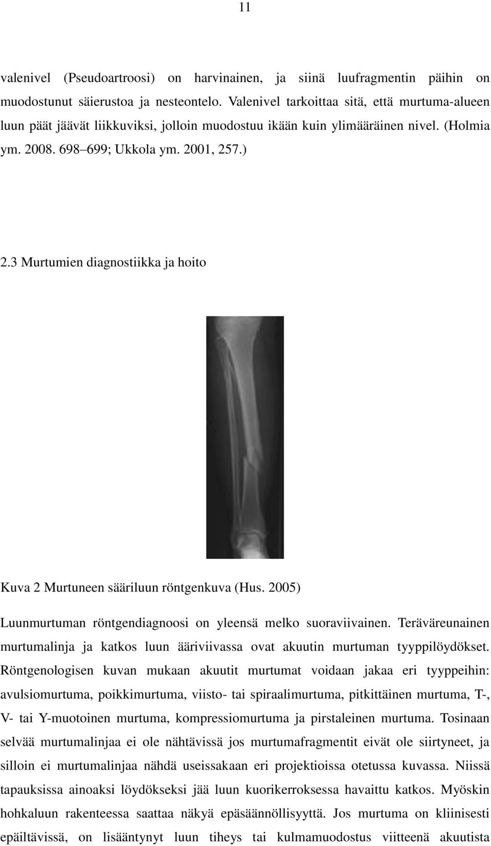 3 Murtumien diagnostiikka ja hoito Kuva 2 Murtuneen sääriluun röntgenkuva (Hus. 2005) Luunmurtuman röntgendiagnoosi on yleensä melko suoraviivainen.