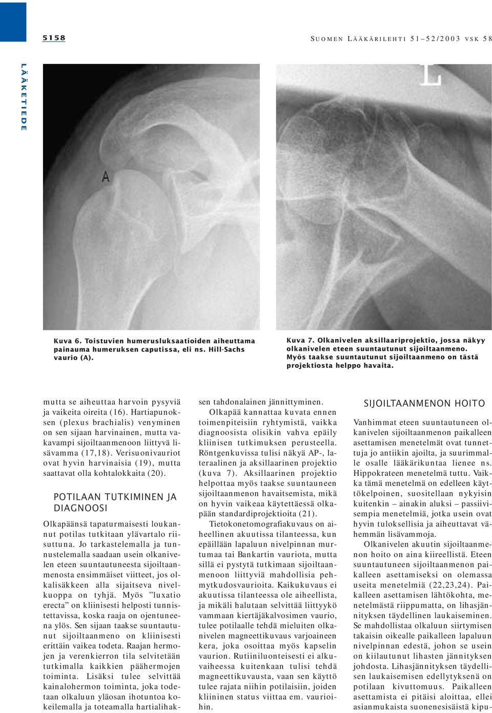 mutta se aiheuttaa harvoin pysyviä ja vaikeita oireita (16). Hartiapunoksen (plexus brachialis) venyminen on sen sijaan harvinainen, mutta vakavampi sijoiltaanmenoon liittyvä lisävamma (17,18).