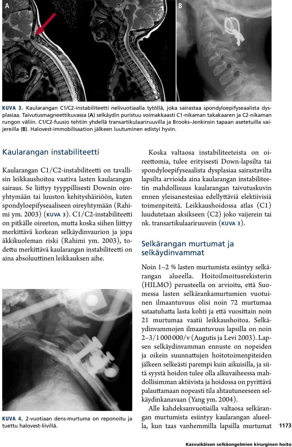 C1/C2-fuusio tehtiin yhdellä transartikulaariruuvilla ja Brooks Jenkinsin tapaan asetetuilla vaijereilla (B). Halovest-immobilisaation jälkeen luutuminen edistyi hyvin.