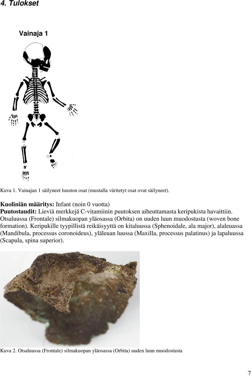 Otsaluussa (Frontale) silmakuopan yläosassa (Orbita) on uuden luun muodostusta (woven bone formation).