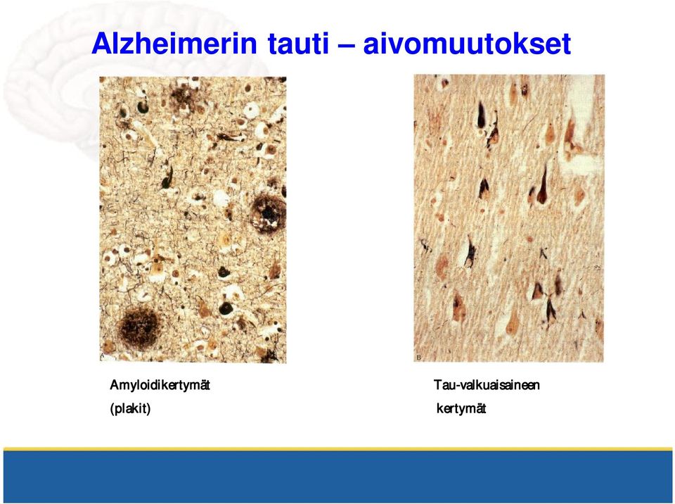 Amyloidikertymät