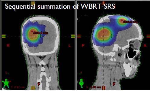 WBRT+boost SIB?