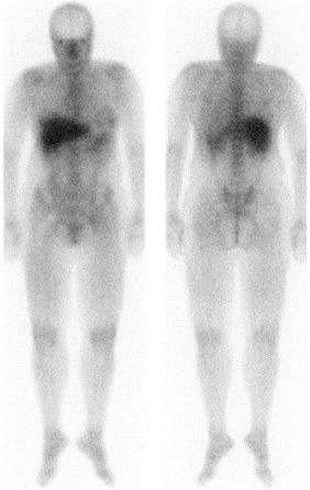 Funktionaalinen kuvausmenetelmä Diagnostiikka Tuntemattomien tautien paikantaminen Staging Hoidon