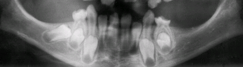 Hampaan kehitystä säätelevät signaaliverkostot Oligodontiaa aiheuttavia geenejä Hiiri Ihminen Mutaatiot vihreissä geeneissä johtavat hampaiden puuttumiseen.