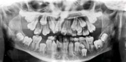 Tavallisesti hiirillä on 3 poskihammasta Ektodysplasiini pelastaa hampaiden kehityksen syntymän jälkeen koirassa, jolla on Ektodermaalinen dysplasia (HED) HED HED + Eda Terve koira Eda -/- hiiren