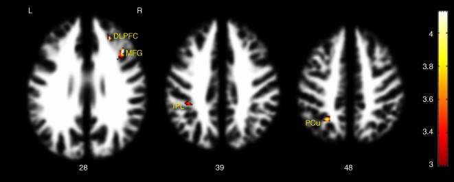 Cerebral white ma-er volume changes in pa6ents with obsessive compulsive disorder: Voxel- based morphometry Psychiatry and Clinical Neurosciences