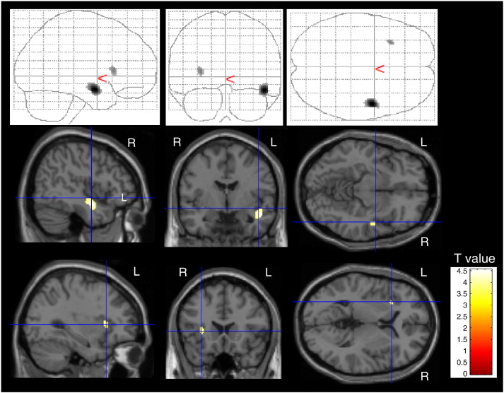 Fig. 1. Areas of reduced [11C]DASB binding potential (BPND) in patients with OCD relative to healthy controls.