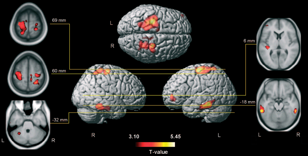 Effects of long- term musical activities Larger gray matter areas in adult musicians (Schlaug et al.