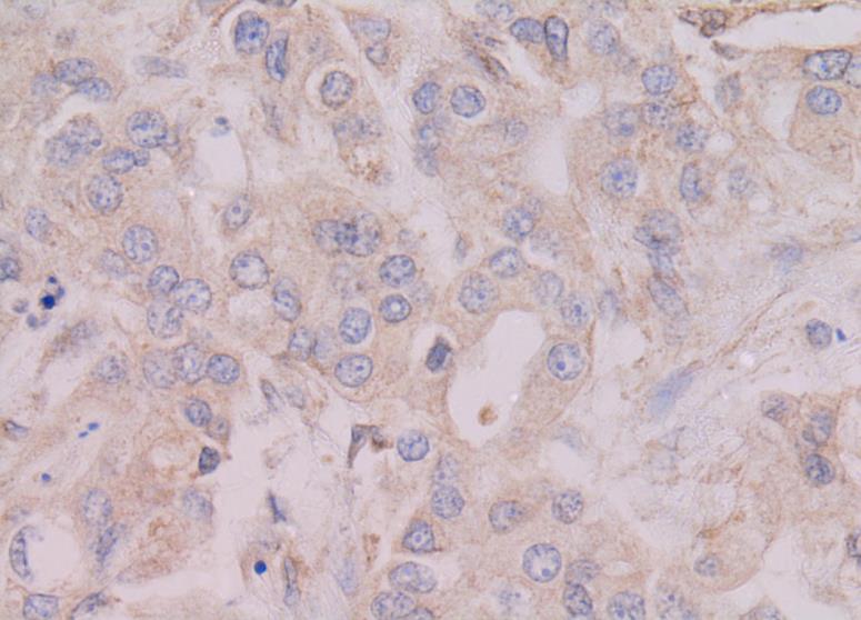 12 A B C D KUVA 1. Hepsiinin ja TMPRSS3:n immunohistokemiallinen värjäytyminen invasiivisissa, duktaalisissa rintasyöpänäytteissä.