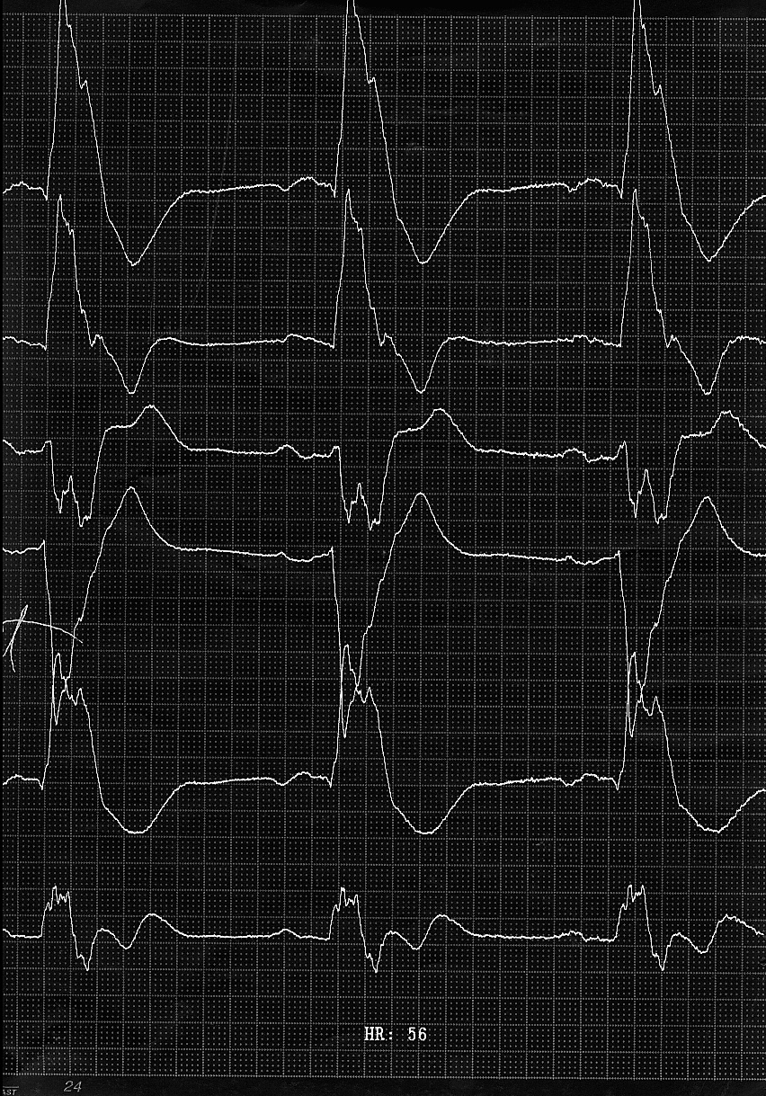 A B KUVA 2. Ennen resynkronisaatiota EKG:ssä nähdään leveä, yli > 200 ms kestävä kammioheilahdus (A). Tahdistimen asennuksen jälkeen kammioheilahdus (B) on selvästi lyhytkestoisempi (160 ms).