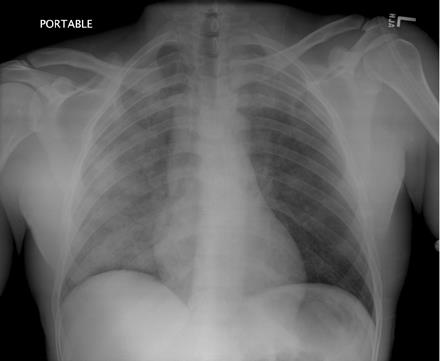 Negative Pressure Pulmonary Edema Chest X-ray showing bilateral infiltrates, right greater than left, suggestive of pulmonary edema: The film was taken immediately after the