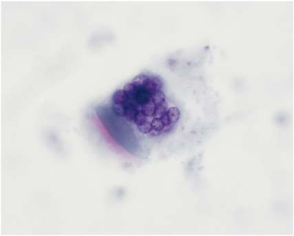 6 Kuvio 3. Keuhkohuuhtelunestenäyte. Monitumainen solu, jonka perusteella voidaan epäillä esimerkiksi respiratory syncytial -virusinfektiota. (Kaarteenaho Pääkkö Anttila 2012: 544.