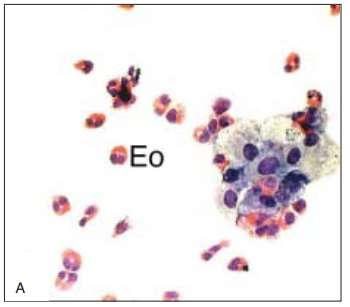 13 Kuvio 5. Keuhkohuuhtelunäyte: eosinofiilinen pneumonia on selvästi diagnosoitavissa BALtutkimuksen soluista (Myllärniemi ym. 2005: 3130).
