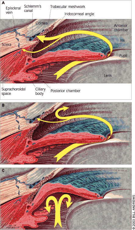 KUVA 1 Iridokorneaalinen kammiokulma. Kuvassa A normaali silmänsisäisen nesteen ulosvirtaus trabekkelivyöhykkeen ja uveoskleraalisen tien läpi.