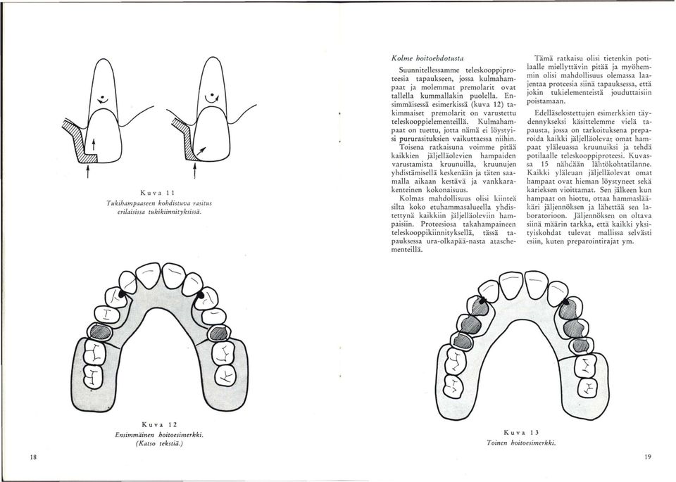 Ensimmäisessä esimerkissä (kuva 12) takimmaiset premoiarit on varustettu teieskooppieiementeiiiä. Kulmahampaat on tuettu, jotta nämä ei löystyisi pururasituksien vaikuttaessa niihin.