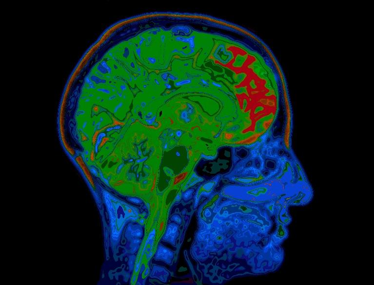 Tutkimus Mindfulness practice leads to increases in regional brain gray matter density (Hölzel B et al 2011) The results suggest that participation in MBSR is associated with changes in gray matter