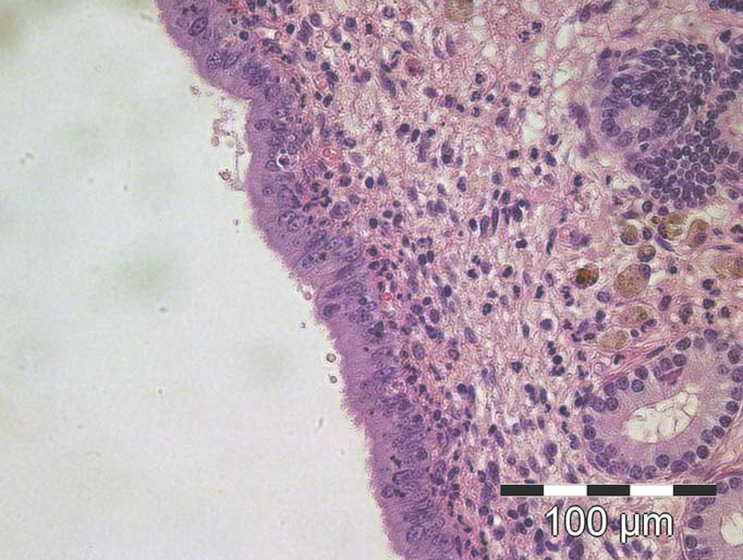 Kuva 7.2. Muutamia hemosiderofageja stratum spongiosumissa Rappeumamuutokset, rauhaset ja nestekierto Kruskal-Wallisin testillä tutkittiin endometriumin rauhasten laajeneminen (kuvaaja 7.
