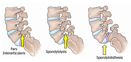 27 eteenpäin alla sijaitsevan nikaman suhteen tai sen yhteydessä. (Huttunen 2002, 207.) Spondylolyysiin liittyy spondylolisteesi noin 50 %:ssa tapauksista.