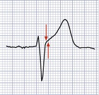 15 Kuvio 8. Normaali EKG-käyrä (Mäkijärvi 2003,41). Sydänlihaksen hapenpuute aiheuttaa sydänlihaksen sähköiseen toimintaan häiriön.