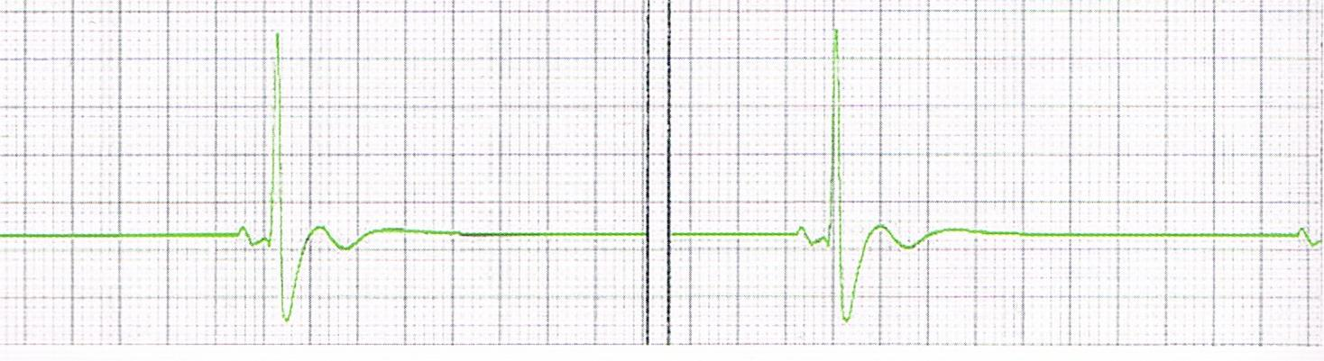 3.1.13 Sykkeetön rytmi 17 Sykkeetön rytmi eli Pulseless Electrical Activity (PEA) on järjestyneeltä näyttävä rytmi. Se on nopeudeltaan yleensä alle 100/minuutissa (Kuva 19.). PEA-potilaalta ei löydy kuitenkaan karotissykettä.